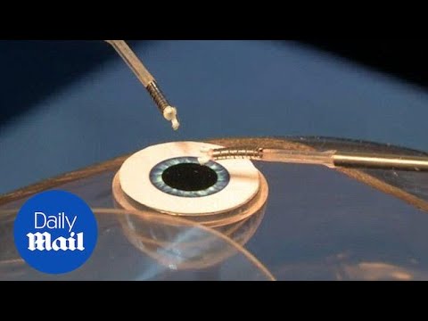 Researchers create robot with tentacles for cataract surgery - Daily Mail